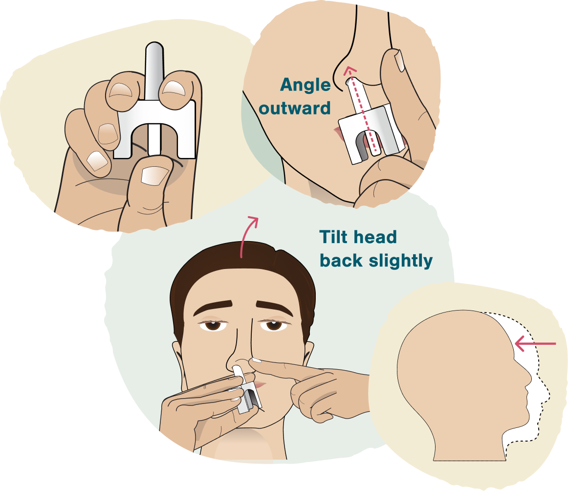 Illustration showing how to hold Tosymra nasal spray upright, insert nozzle into nostril angled outward, and tilt head back slightly
